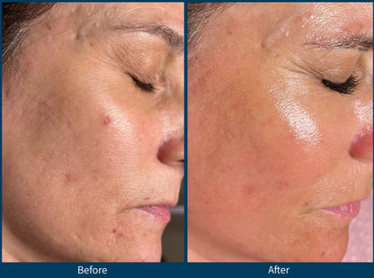 NA Rejuvaskin™ Silicone Scar Cream NA