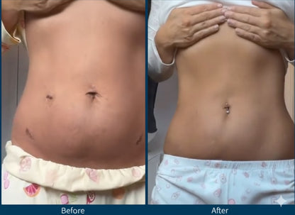 NA Rejuvaskin™ Silicone Scar Cream NA